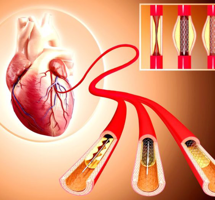 coronary angioplasty